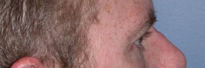 Eyelid Lift Before & After Gallery - Patient 4756968 - Image 6