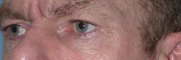 Eyelid Lift Gallery Before & After Gallery - Patient 4756968 - Image 7
