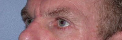 Eyelid Lift Gallery Before & After Gallery - Patient 4756968 - Image 8