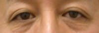 Eyelid Lift Gallery Before & After Gallery - Patient 4756971 - Image 1