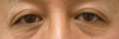 Eyelid Lift Gallery Before & After Gallery - Patient 4756971 - Image 1