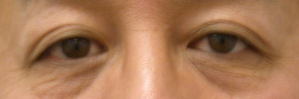 Eyelid Lift Gallery Before & After Gallery - Patient 4756971 - Image 1