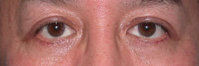 Eyelid Lift Gallery Before & After Gallery - Patient 4756971 - Image 2
