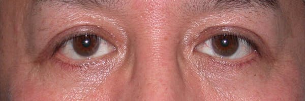 Eyelid Lift Before & After Gallery - Patient 4756971 - Image 2