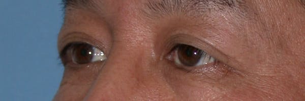 Eyelid Lift Gallery Before & After Gallery - Patient 4756971 - Image 3