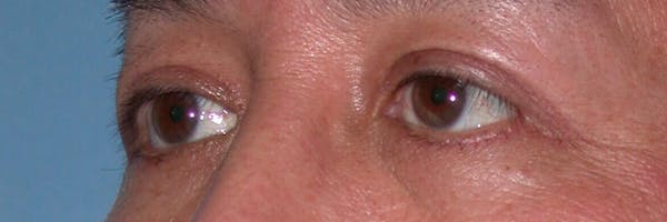 Eyelid Lift Gallery Before & After Gallery - Patient 4756971 - Image 4