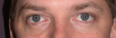 Eyelid Lift Gallery Before & After Gallery - Patient 4756973 - Image 2