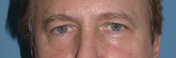 Eyelid Lift Before & After Gallery - Patient 4756984 - Image 1