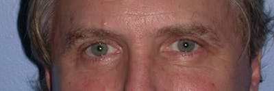 Eyelid Lift Gallery Before & After Gallery - Patient 4756984 - Image 2