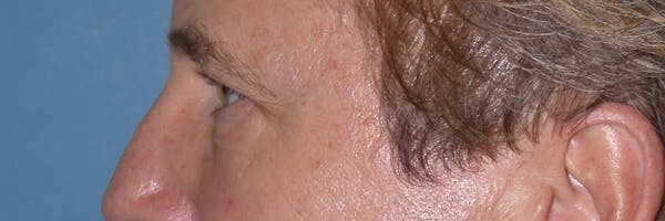 Eyelid Lift Before & After Gallery - Patient 4756984 - Image 5