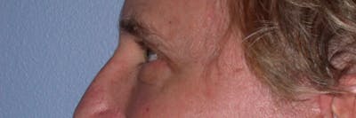 Eyelid Lift Before & After Gallery - Patient 4756984 - Image 6