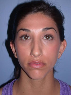 Before & After Otoplasty San Francisco