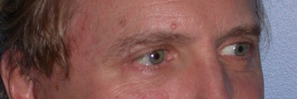 Eyelid Lift Gallery Before & After Gallery - Patient 4756984 - Image 8