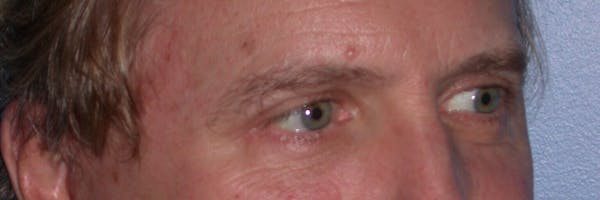 Eyelid Lift Before & After Gallery - Patient 4756984 - Image 8