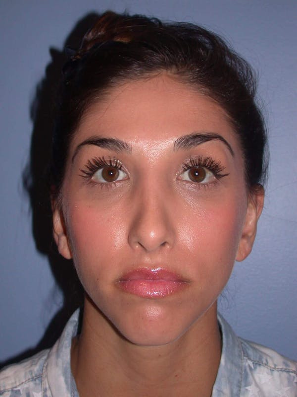 Before & After Otoplasty San Francisco