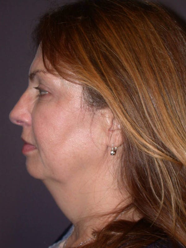 Before & After neck lift in San Francisco