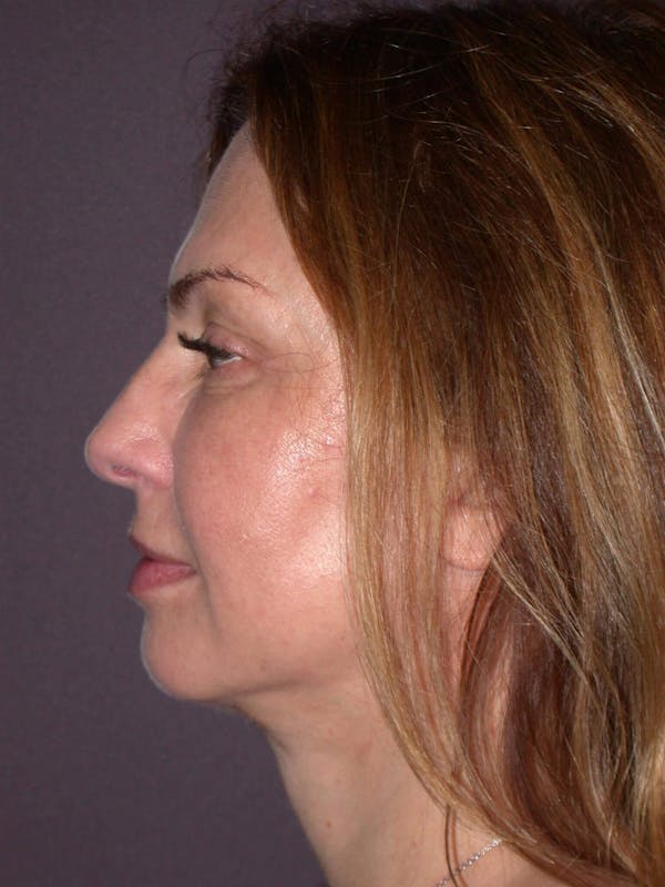 Before & After neck lift in San Francisco