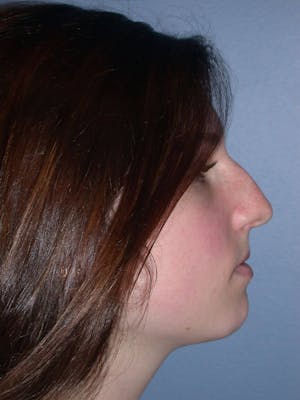 Before & After Rhinoplasty San Francisco