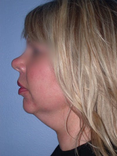 Neck Lift Gallery Before & After Gallery - Patient 4757148 - Image 1