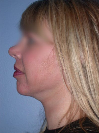 Neck Lift Gallery Before & After Gallery - Patient 4757148 - Image 2