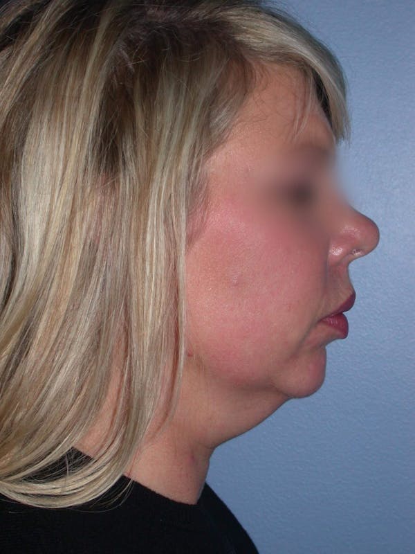 Neck Lift Gallery Before & After Gallery - Patient 4757148 - Image 3