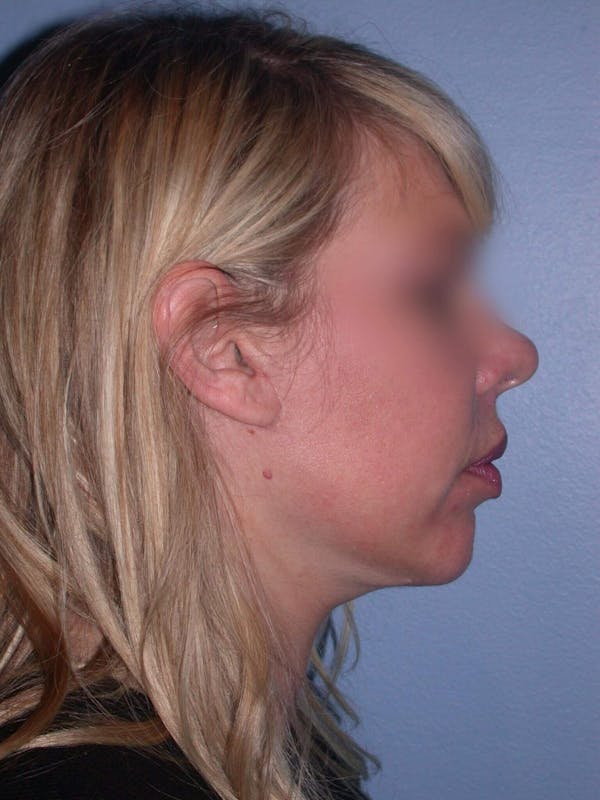 Neck Lift Gallery Before & After Gallery - Patient 4757148 - Image 4