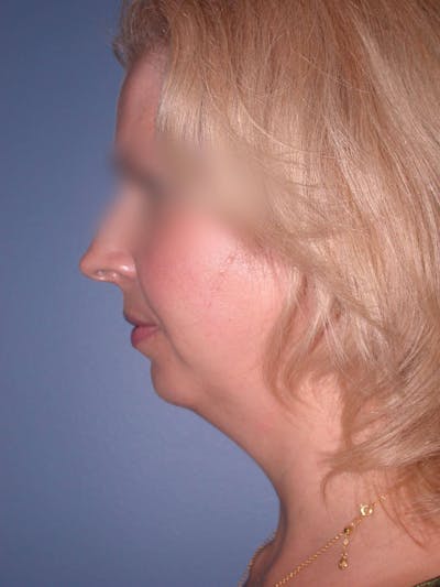 Neck Lift Gallery Before & After Gallery - Patient 4757158 - Image 1