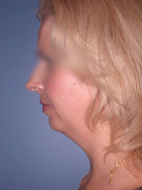 Neck Lift Before & After Gallery - Patient 4757158 - Image 1