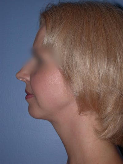 Neck Lift Gallery Before & After Gallery - Patient 4757158 - Image 2