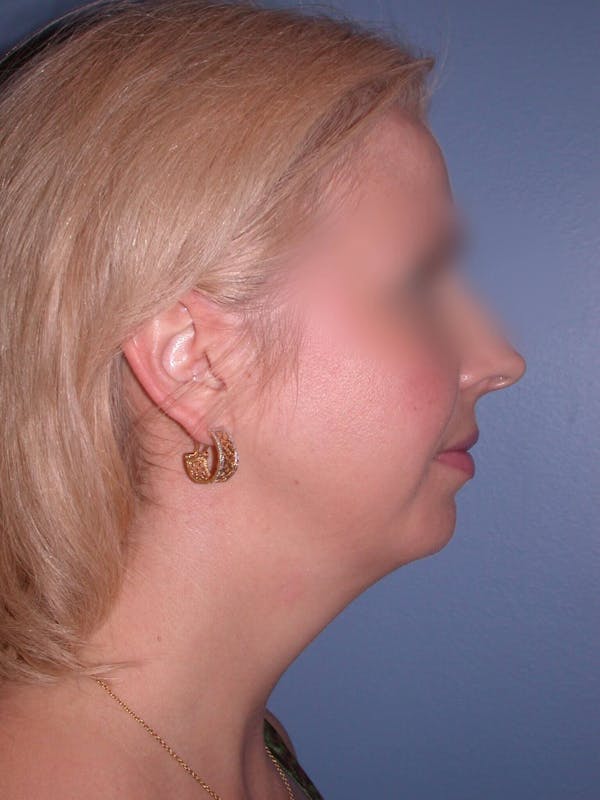 Neck Lift Gallery Before & After Gallery - Patient 4757158 - Image 3