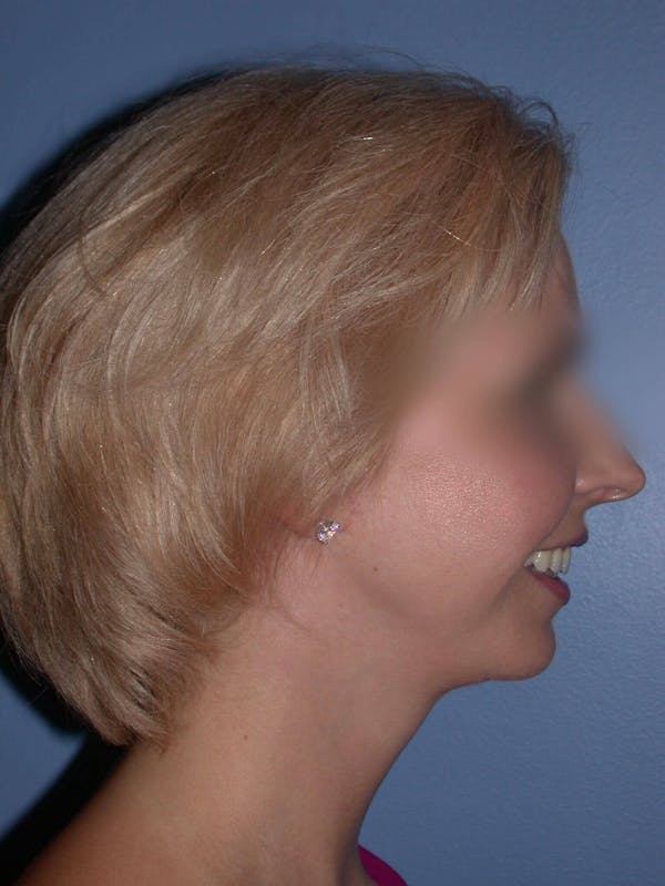 Neck Lift Gallery Before & After Gallery - Patient 4757158 - Image 4