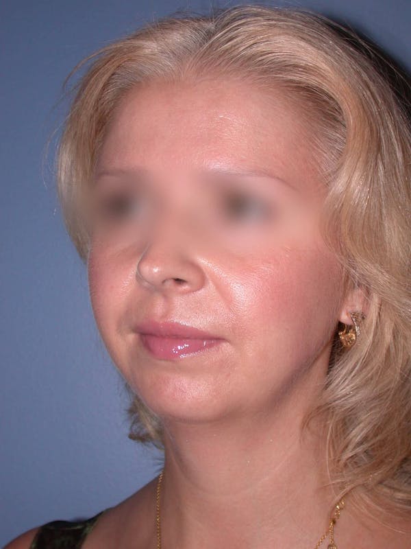 Neck Lift Before & After Gallery - Patient 4757158 - Image 5