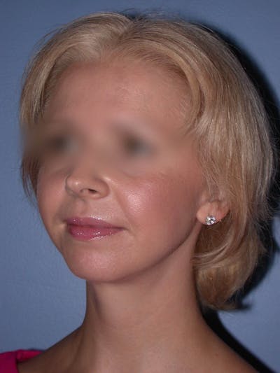 Neck Lift Gallery Before & After Gallery - Patient 4757158 - Image 6