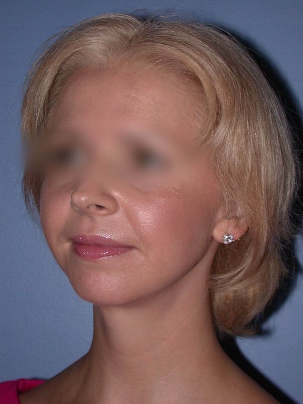 Neck Lift Before & After Gallery - Patient 4757158 - Image 6