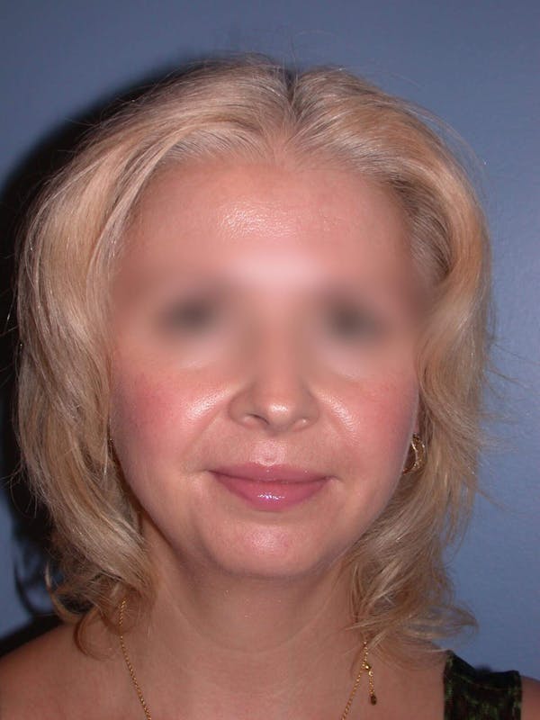 Neck Lift Gallery Before & After Gallery - Patient 4757158 - Image 7