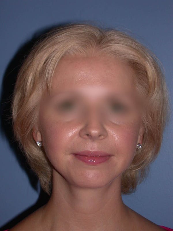 Neck Lift Before & After Gallery - Patient 4757158 - Image 8