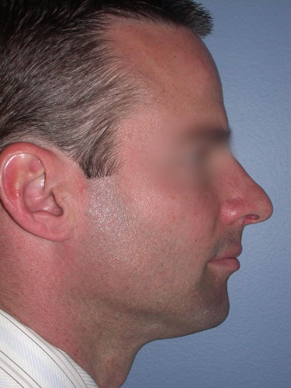 Rhinoplasty