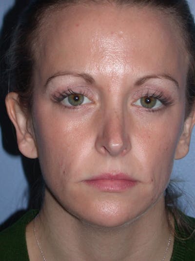 Rhinoplasty Gallery Before & After Gallery - Patient 4757180 - Image 1