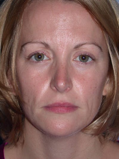 Rhinoplasty Gallery Before & After Gallery - Patient 4757180 - Image 2
