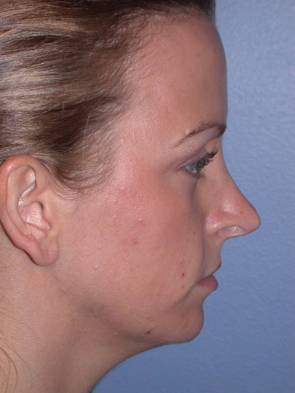 Rhinoplasty Gallery Before & After Gallery - Patient 4757180 - Image 3