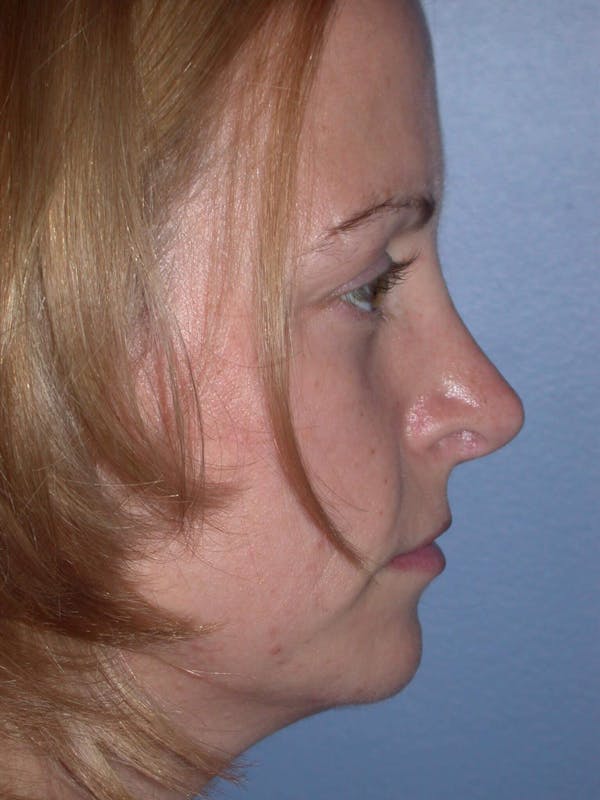 Rhinoplasty Gallery Before & After Gallery - Patient 4757180 - Image 4