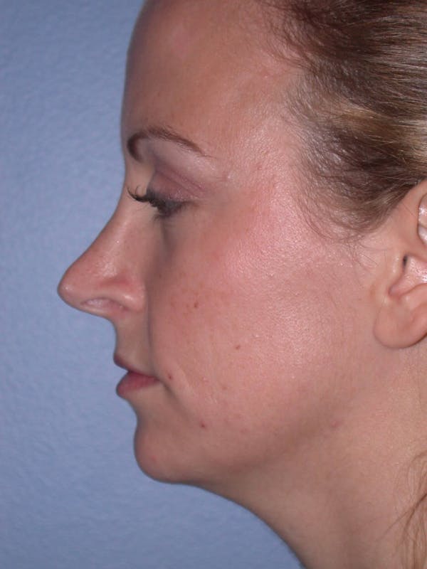 Rhinoplasty Gallery Before & After Gallery - Patient 4757180 - Image 5
