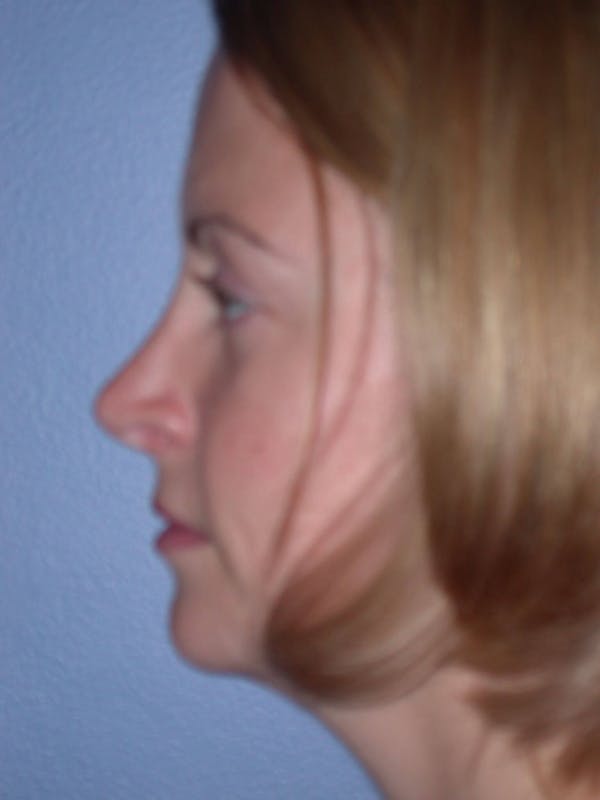 Rhinoplasty Gallery Before & After Gallery - Patient 4757180 - Image 6