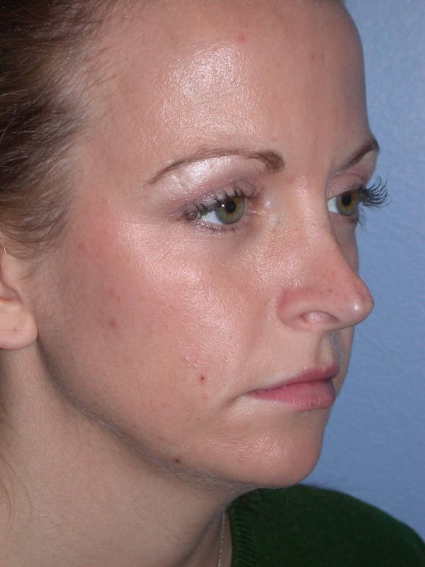 Rhinoplasty Gallery Before & After Gallery - Patient 4757180 - Image 7