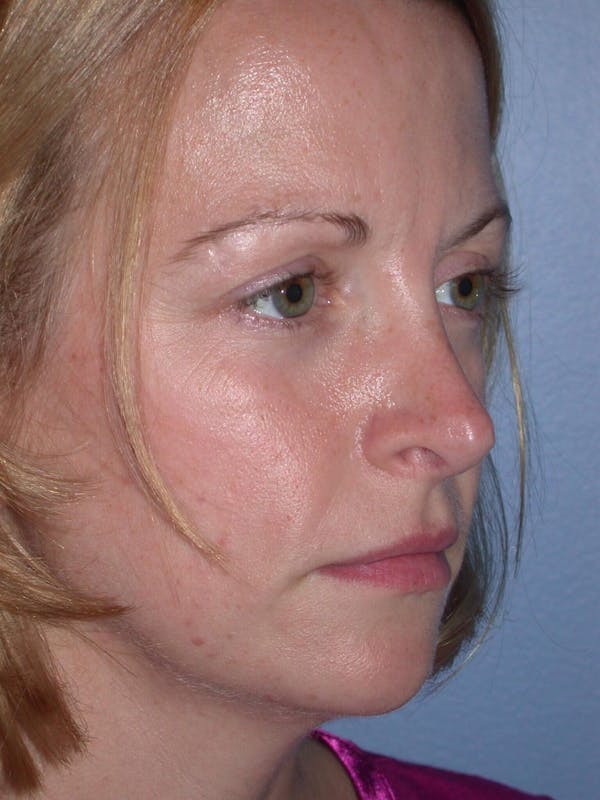 Rhinoplasty Gallery Before & After Gallery - Patient 4757180 - Image 8