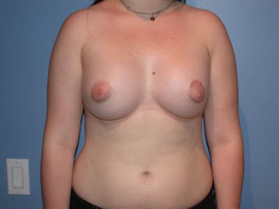 Tubular Breasts Gallery Before & After Gallery - Patient 4757204 - Image 2