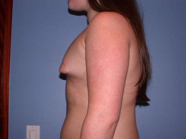 Tubular Breasts Gallery Before & After Gallery - Patient 4757204 - Image 5