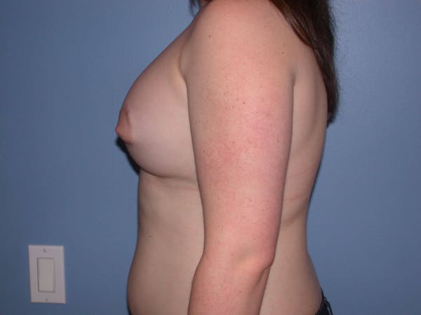 Tubular Breasts Gallery Before & After Gallery - Patient 4757204 - Image 6