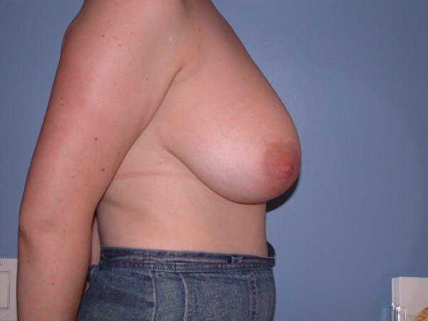 Breast Reduction Before & After Gallery - Patient 4757219 - Image 3