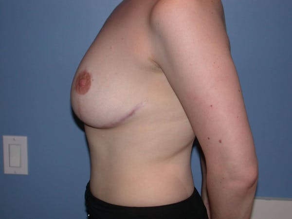 Breast Reduction Before & After Gallery - Patient 4757219 - Image 6